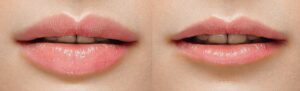 lips 5 e1500487152346