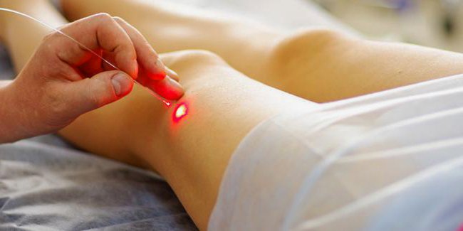 Varis Nedir? Nasıl Tedavi Edilir? 3 varis lazer